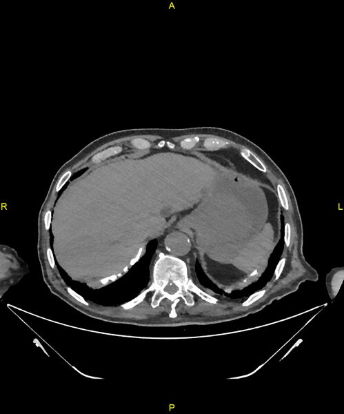 File:Aortoenteric fistula (Radiopaedia 84308-99603 Axial non-contrast 37).jpg