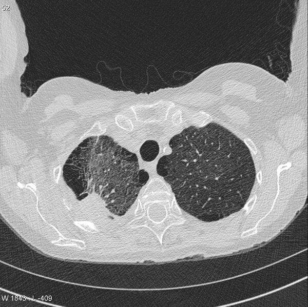 File:Apical non-small-cell lung cancer (Radiopaedia 8570-9405 Axial lung window 7).jpg