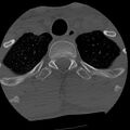 Apical pneumothorax on cervical spine CT (Radiopaedia 45343-49368 Axial bone window 92).jpg
