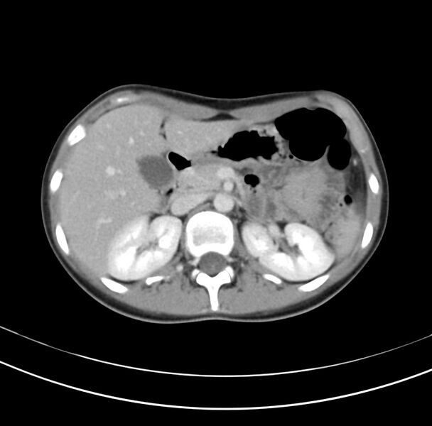 File:Appendicitis and incidental bicornuate uterus (Radiopaedia 22833-22853 B 13).jpg
