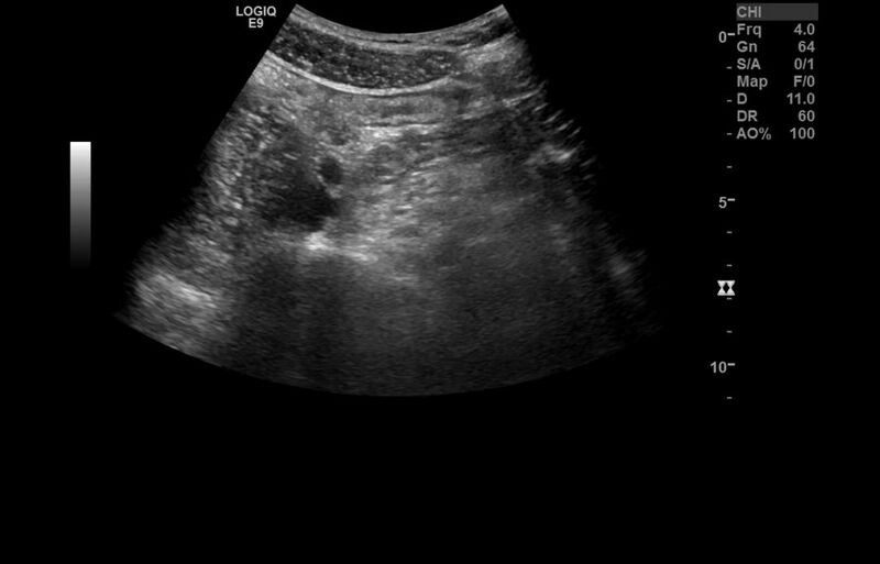File:Appendicitis and incidental foregut duplication cyst (Radiopaedia 52962-58918 A 18).jpg
