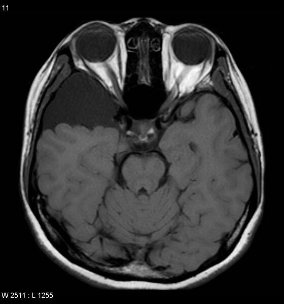 File:Arachnoid cyst - middle cranial fossa (Radiopaedia 4768-6774 Axial T1 1).jpg