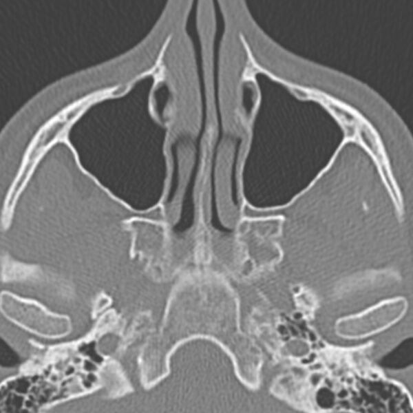 File:Arrested pneumatization of the sphenoid (Radiopaedia 10700-11172 Axial non-contrast 10).jpg