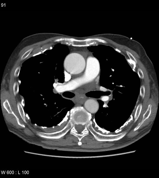 File:Asbestos related lung and pleural disease (Radiopaedia 14377-14301 D 27).jpg