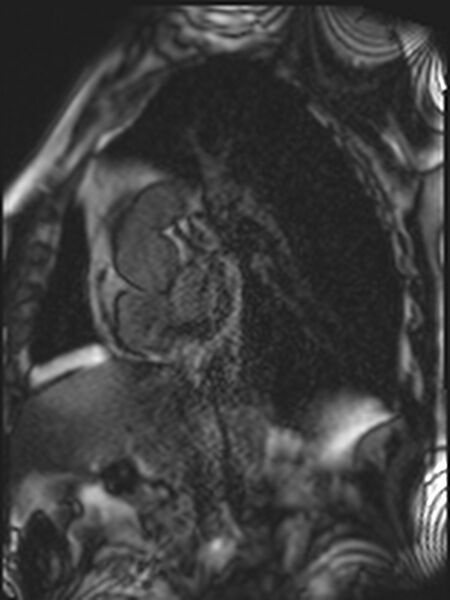 File:Asymmetric septal hypertrophic cardiomyopathy - systolic anterior motion of mitral leaflet (Radiopaedia 72795-83445 D 2).jpg