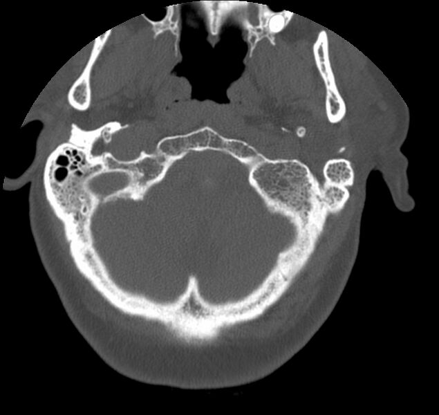 File:Atlanto-occipital assimilation with basilar invagination (Radiopaedia 70122-80188 Axial bone window 7).jpg