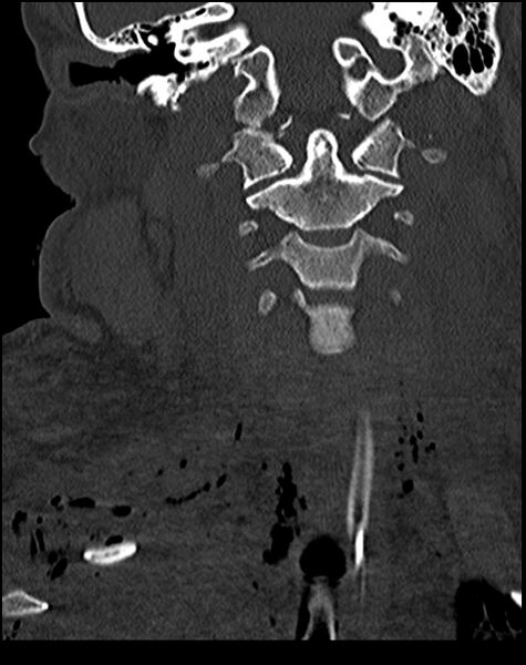 File:Atlanto-occipital dissociation - Traynelis type 1 (Radiopaedia 87570-103948 Coronal bone window 28).jpg