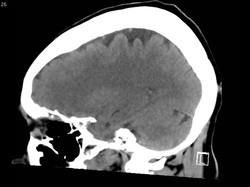 Atypical meningioma - intraosseous (Radiopaedia 64915-73867 C 24).jpg