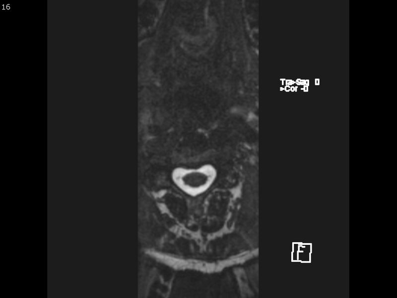 File:Atypical meningioma - intraosseous (Radiopaedia 64915-74572 Axial CISS 16).jpg