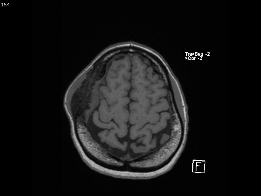 Atypical meningioma - intraosseous (Radiopaedia 64915-74572 Axial T1 154).jpg