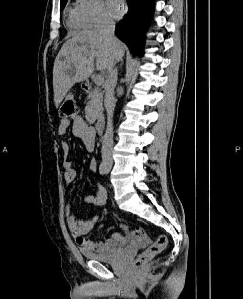 File:Autosomal dominant polycystic kidney disease (Radiopaedia 87830-104287 C 41).jpg