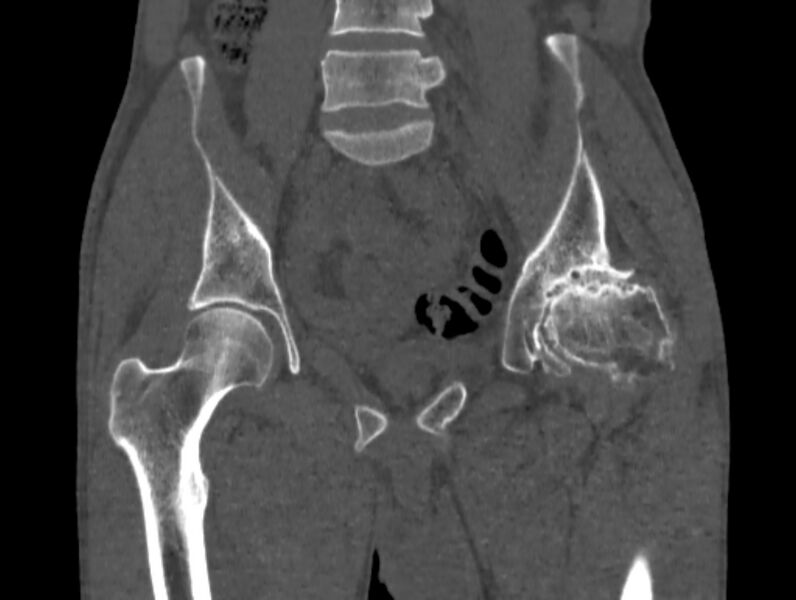 File:Avascular necrosis of the left hip (Radiopaedia 75068-86125 Coronal bone window 27).jpg