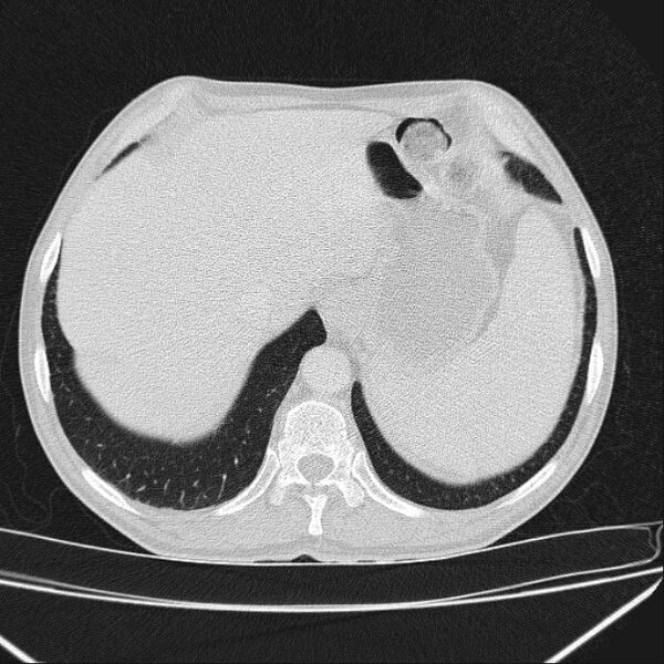 File:Azygos lobe (Radiopaedia 38259-40275 Axial lung window 72).jpg