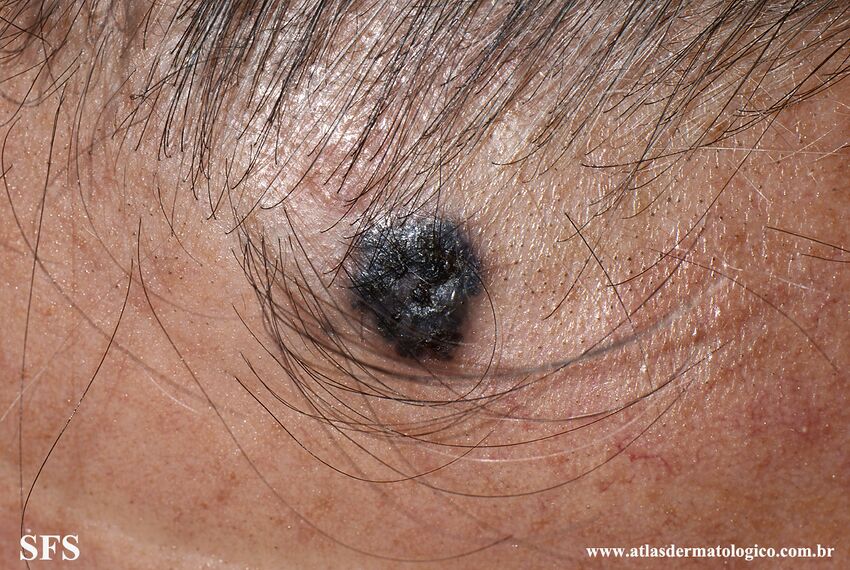 Basal Cell Carcinoma (Dermatology Atlas 263).jpg