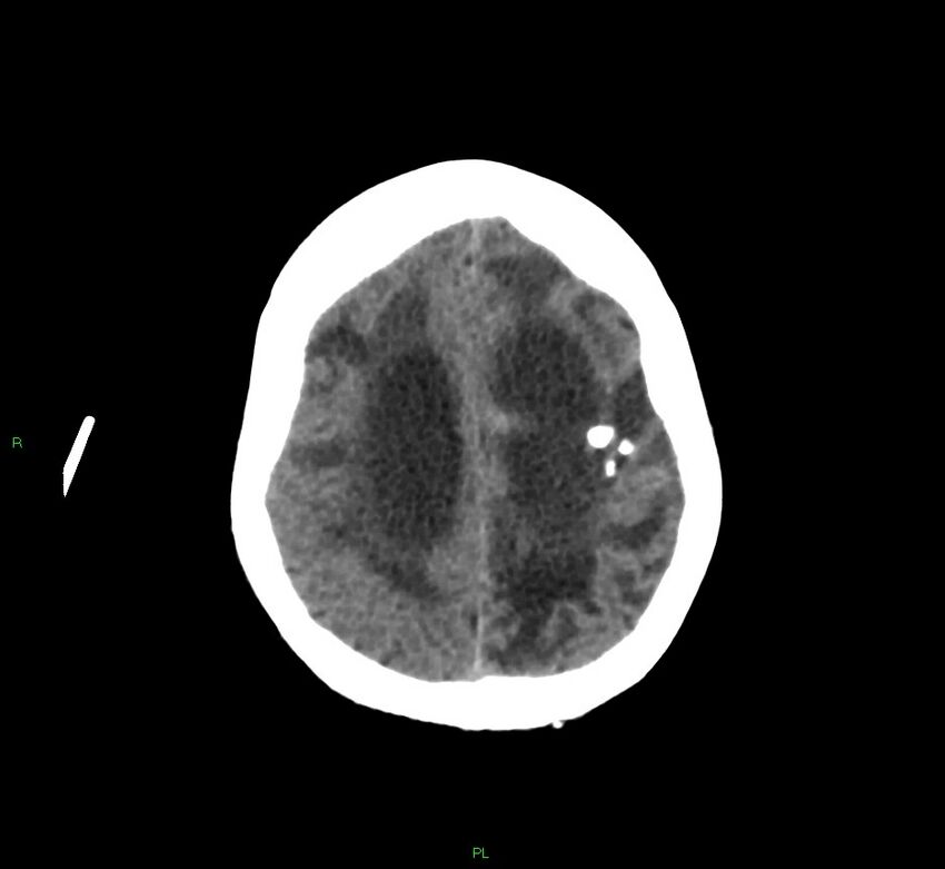 Basal ganglia hemorrhage (Radiopaedia 58766-65988 Axial non-contrast 18).jpg