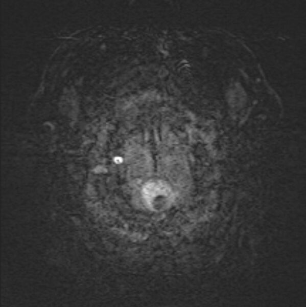 File:Basilar artery dissection (Radiopaedia 77032-88976 Axial SWI 1).jpg