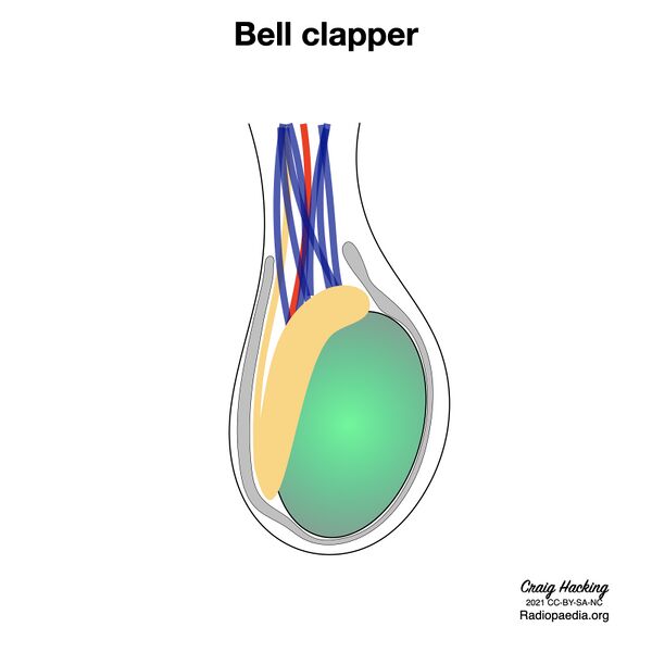 File:Bell clapper deformity (diagram) (Radiopaedia 86124-102079 C 1).jpeg