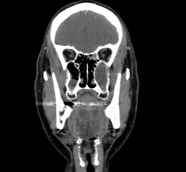 File:Benign mixed salivary tumor of the parotid gland (Radiopaedia 35261-36792 B 8).jpg