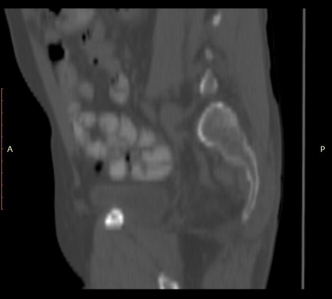 File:Bertolotti syndrome (Radiopaedia 58974-66235 Sagittal bone window 7).jpg