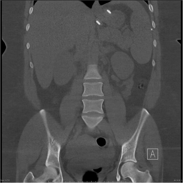 File:Bilateral lumbar ribs (Radiopaedia 25862-26010 Coronal bone window 6).jpg