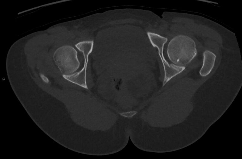 File:Bilateral mature cystic ovarian teratoma (Radiopaedia 88821-105592 Axial bone window 49).jpg