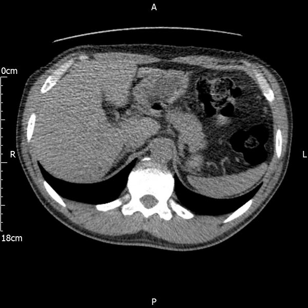 File:Bilateral medullary nephrocalcinosis with ureteric calculi (Radiopaedia 71269-81569 Axial non-contrast 21).jpg