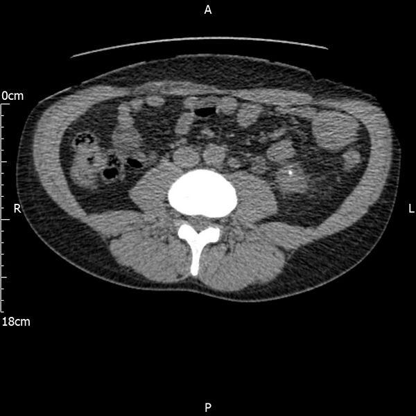 File:Bilateral medullary nephrocalcinosis with ureteric calculi (Radiopaedia 71269-81569 Axial non-contrast 68).jpg