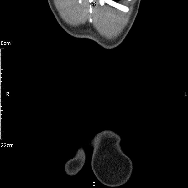 File:Bilateral medullary nephrocalcinosis with ureteric calculi (Radiopaedia 71269-81569 Coronal non-contrast 77).jpg