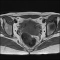 Bilateral ovarian endometriomas (Radiopaedia 87085-103347 Axial T1 13).jpg