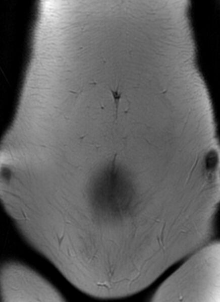 File:Bilateral ovarian fibrothecomas - adolescent (Radiopaedia 86604-102707 Coronal T2 4).jpg