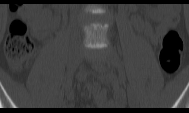 File:Bilateral pars defect (Radiopaedia 26691-26846 Coronal bone window 6).jpg