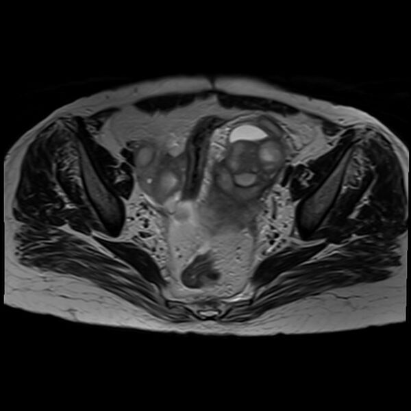 File:Bilateral tubo-ovarian abscesses (Radiopaedia 58635-65829 Axial T2 22).jpg