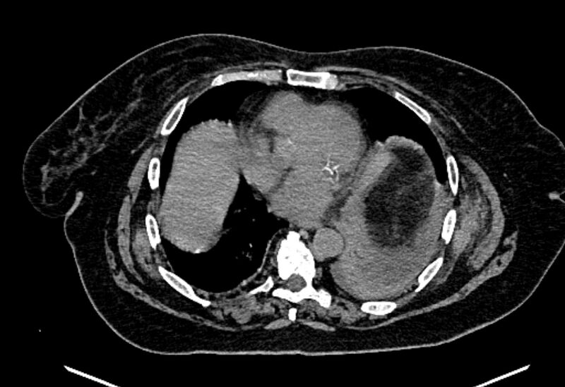 File:Biliary pancreatitis (Radiopaedia 72289-82823 Axial non-contrast 16).jpg