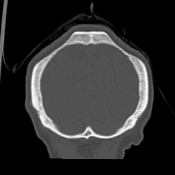 File:Biparietal osteodystrophy (Radiopaedia 46109-50463 Coronal bone window 92).jpg