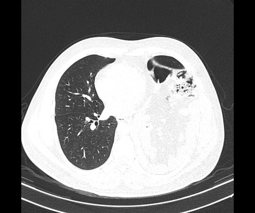 Bochdalek hernia - adult presentation (Radiopaedia 74897-85925 Axial lung window 27).jpg