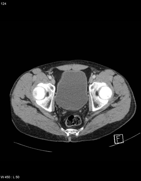 File:Boerhaave syndrome with tension pneumothorax (Radiopaedia 56794-63603 A 62).jpg