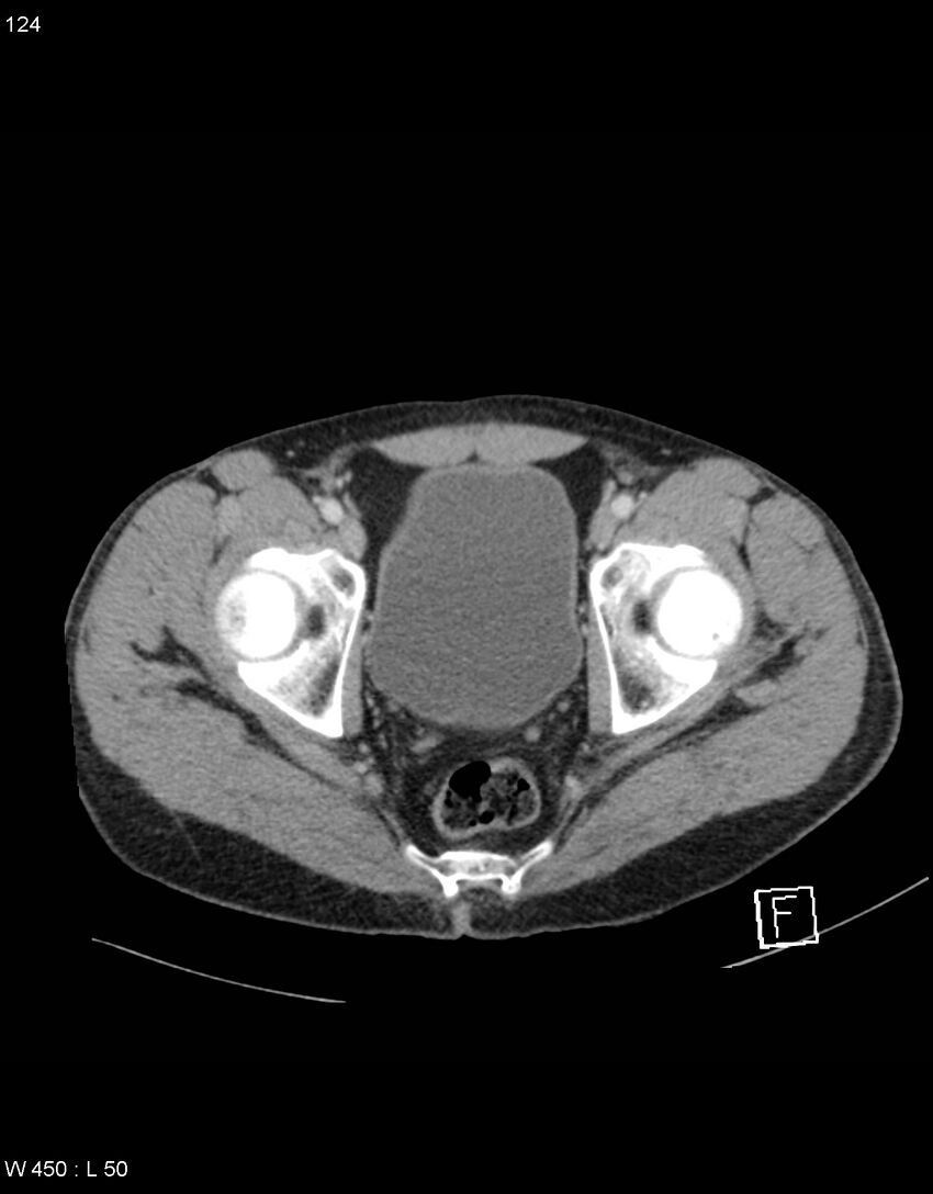 Boerhaave syndrome with tension pneumothorax (Radiopaedia 56794-63603 A 62).jpg