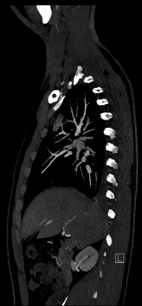 File:Brachiocephalic trunk pseudoaneurysm (Radiopaedia 70978-81191 C 35).jpg