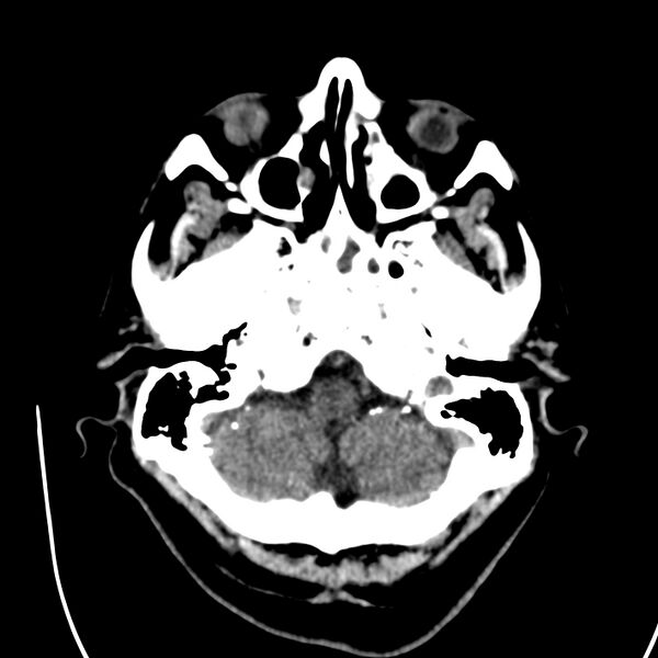 File:Brain Pantopaque remnants (Radiopaedia 78403-91048 Axial non-contrast 24).jpg