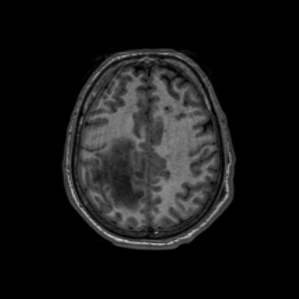 File:Brain abscess complicated by intraventricular rupture and ventriculitis (Radiopaedia 82434-96577 Axial T1 52).jpg