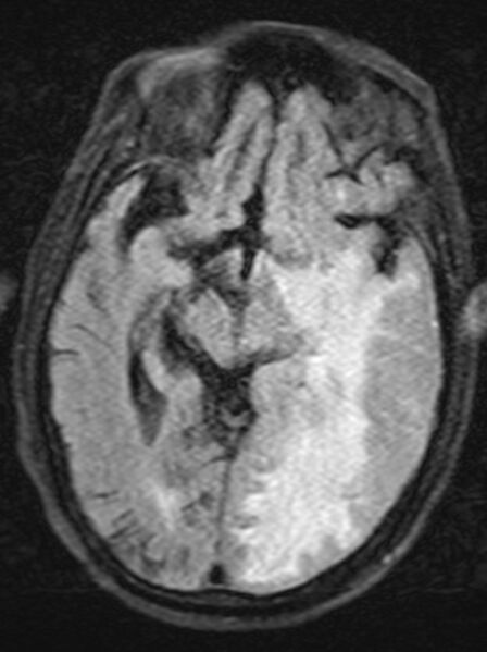 File:Brain abscess with dual rim sign (Radiopaedia 87566-103938 Axial FLAIR 10).jpg