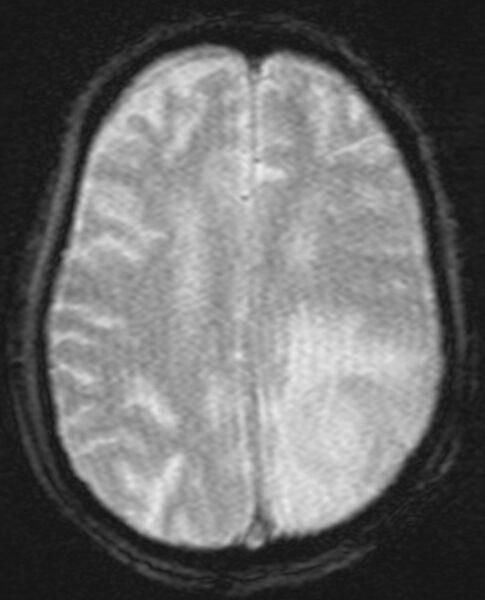 File:Brain abscess with dual rim sign (Radiopaedia 87566-103938 Axial SWI 16).jpg