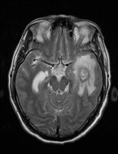 File:Brain abscess with ventriculitis (Radiopaedia 85703-101495 Axial T2 10).jpg