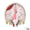 Brain herniation types (Radiopaedia 45683-49865 B 1).jpg