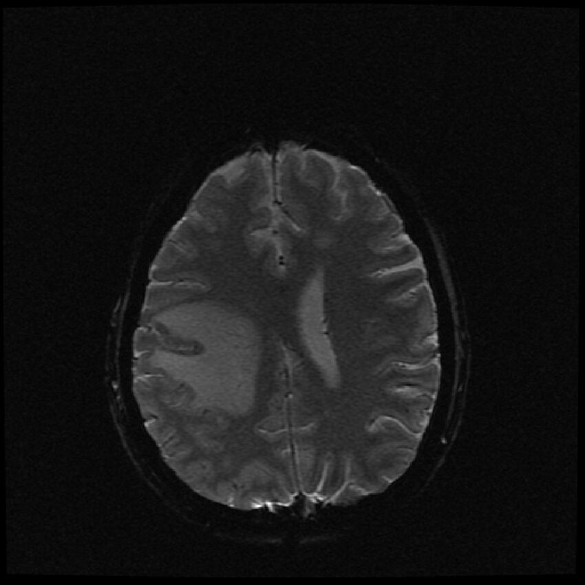 Brain metastases (renal cell carcinoma) (Radiopaedia 42571-45704 Axial SWI 18).jpg