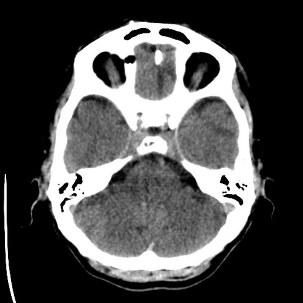 File:Brain metastases from lung cancer (Radiopaedia 24480-24781 Axial non-contrast 10).jpg