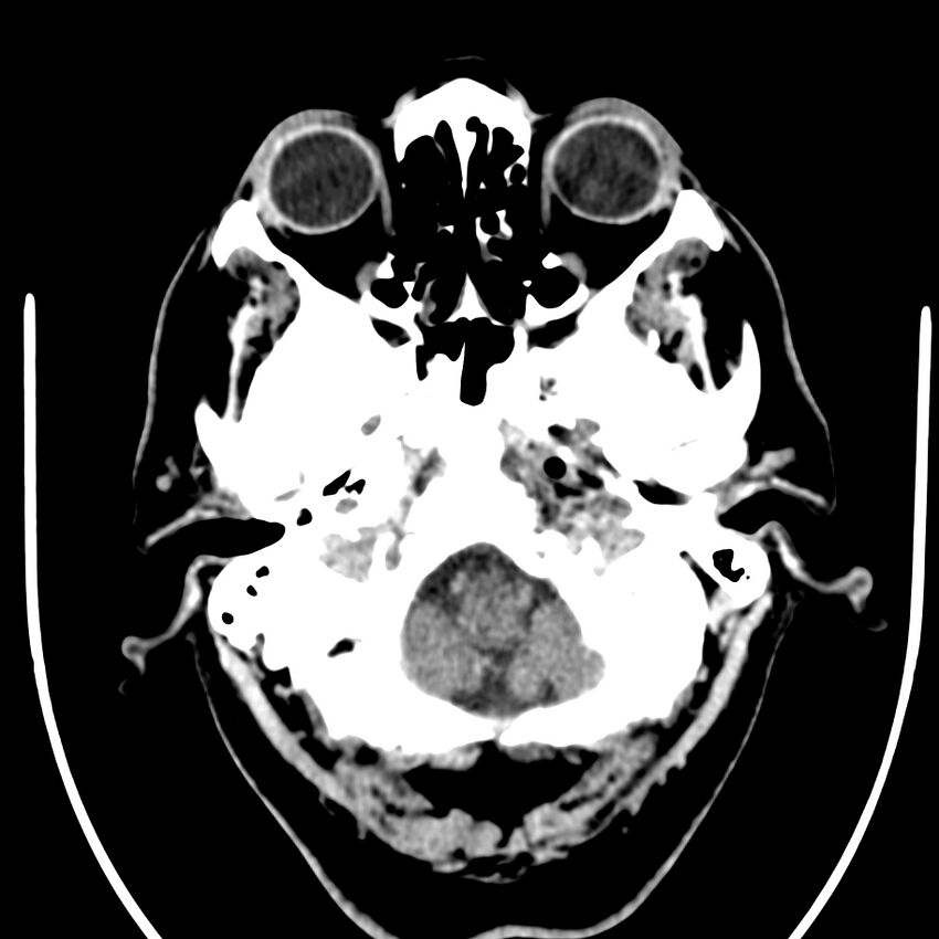 Brain metastasis (Radiopaedia 42617-45760 Axial non-contrast 3).jpg