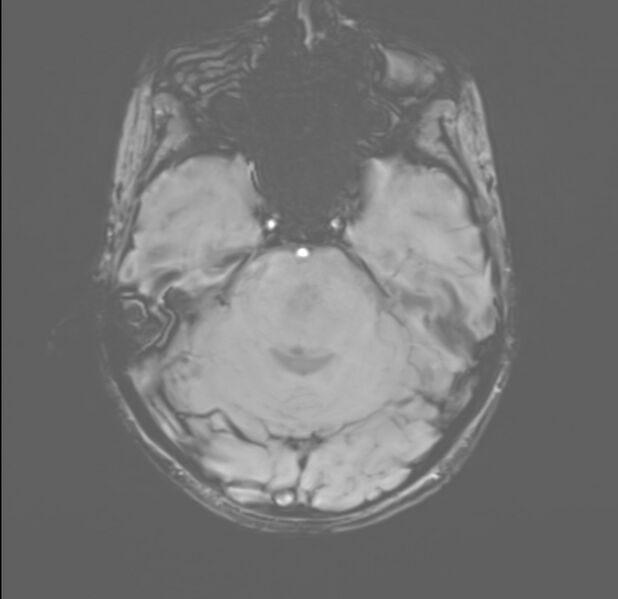 File:Brainstem glioma (Radiopaedia 70548-80674 Axial SWI 15).jpg