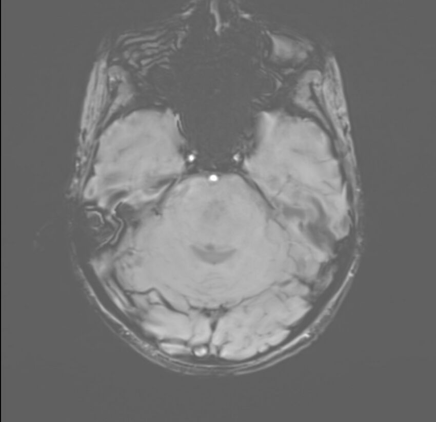 Brainstem glioma (Radiopaedia 70548-80674 Axial SWI 15).jpg