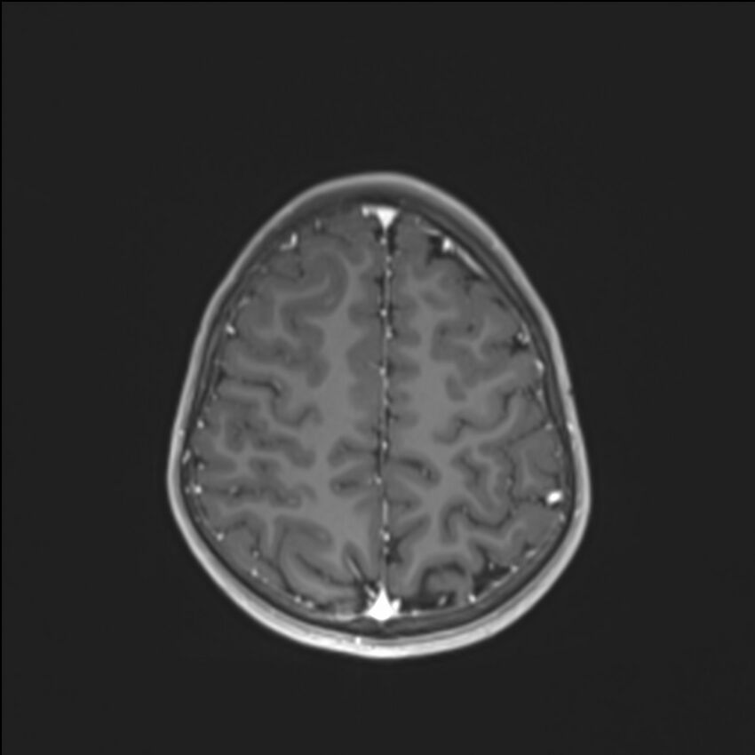 Brainstem glioma (Radiopaedia 70548-80674 Axial T1 C+ 124).jpg
